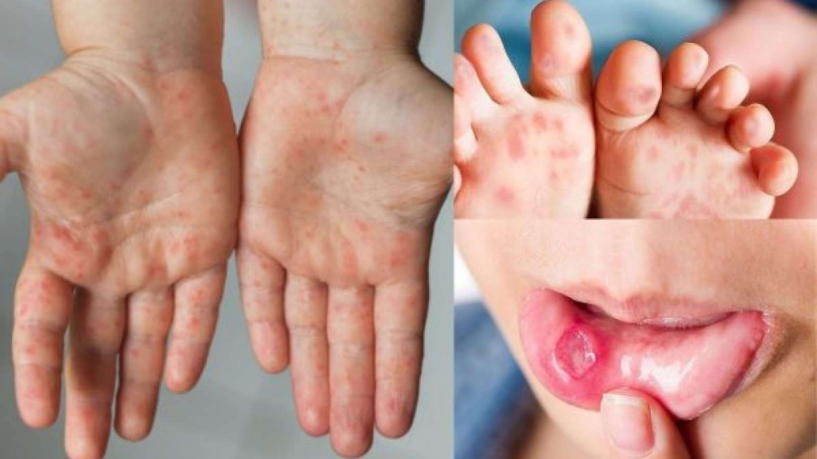 HFM disease claims for lives across southern Vietnam