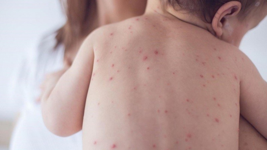 Doctors warn of abnormal rise in chickenpox cases this summer