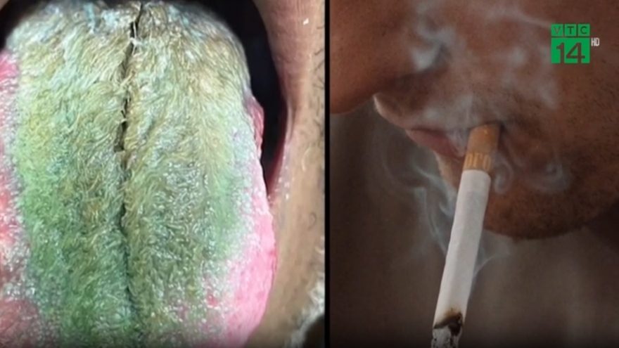 Lưỡi chuyển màu xanh sau khi dùng thuốc kháng sinh và hút thuốc lá