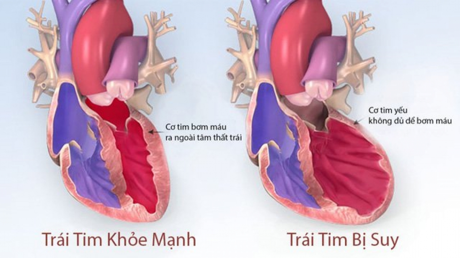 Bé 1 tuổi bị cao huyết áp