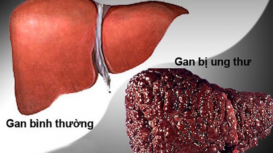 Ung thư gan có số ca tử vong dẫn đầu