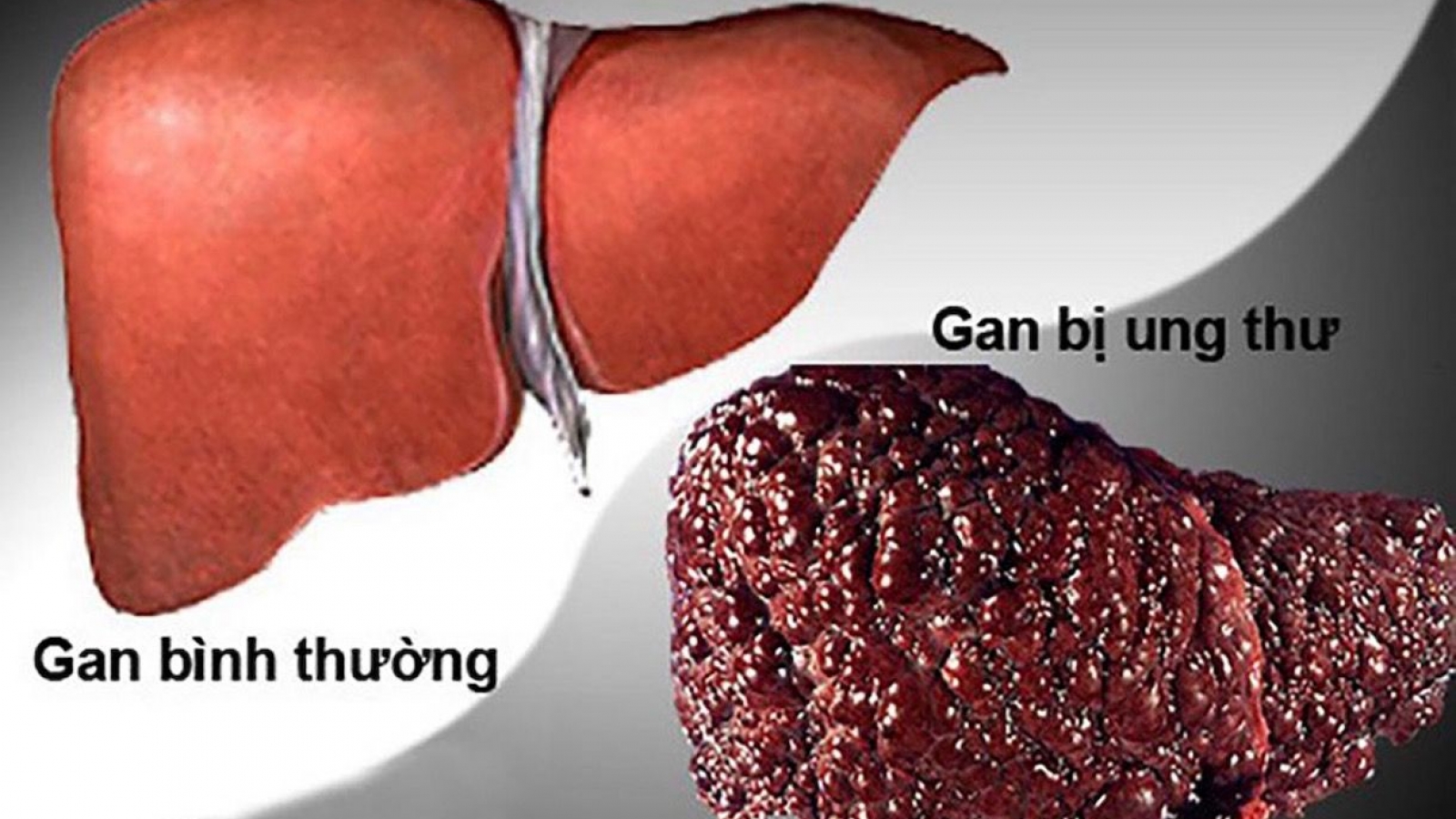 Ung thư gan có số ca tử vong dẫn đầu