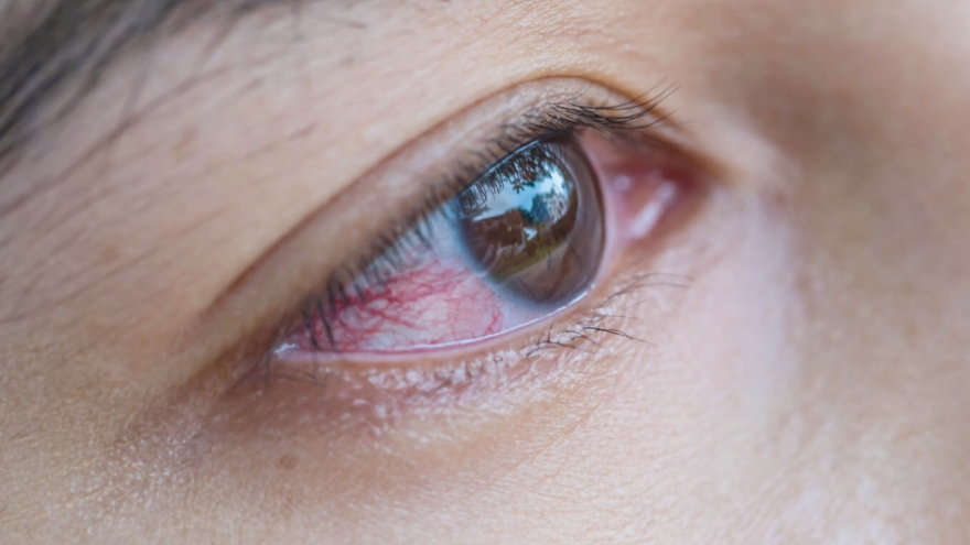 Các biện pháp khắc phục tại nhà cho bệnh đau mắt đỏ
