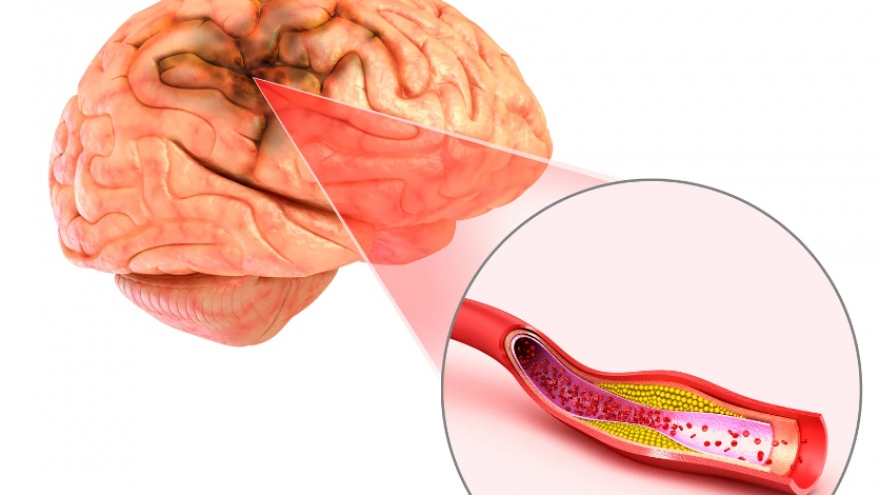 Bệnh viện quốc tế DNA ấp ủ hy vọng giảm ngừa đột quỵ cho người Việt