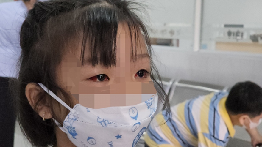 Đau mắt đỏ ở trẻ gia tăng, cảnh báo tình trạng dùng kháng sinh bừa bãi