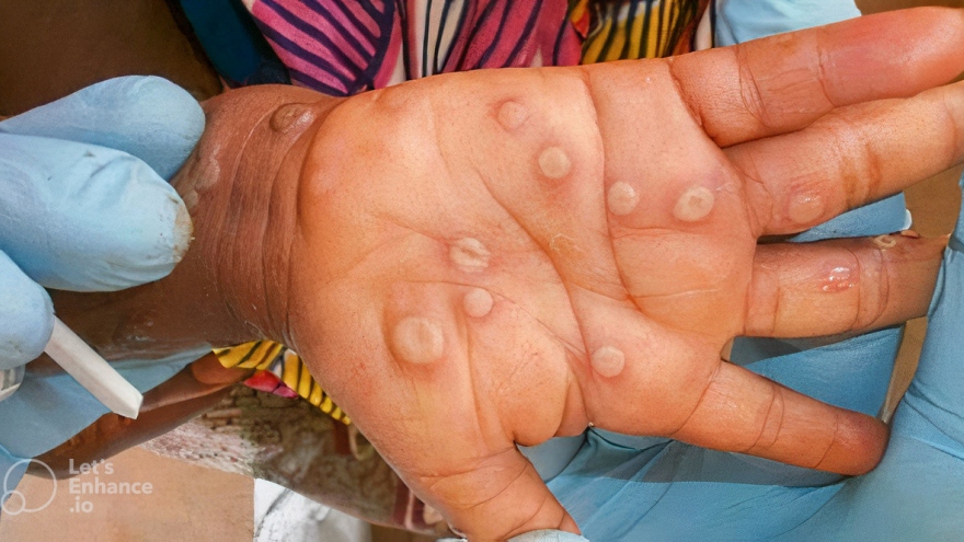 Southern Dong Nai province logs second monkeypox infection