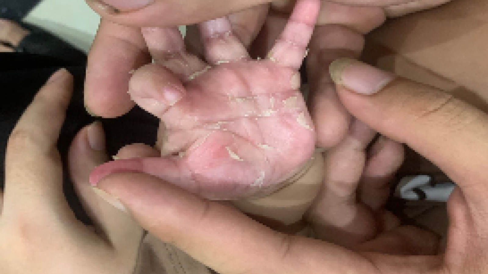 Tại sao trẻ sơ sinh mắc bệnh xã hội?