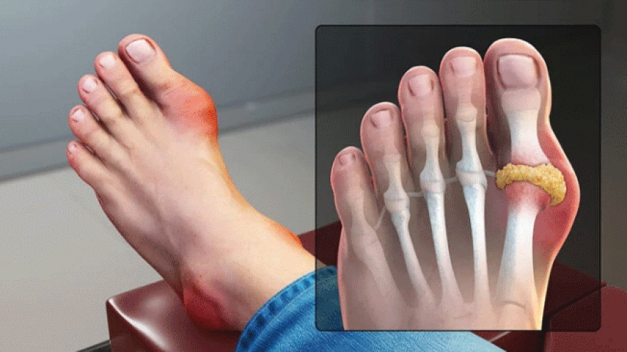 Bệnh gout có xu hướng trẻ hóa, bác sĩ chỉ cách phòng ngừa