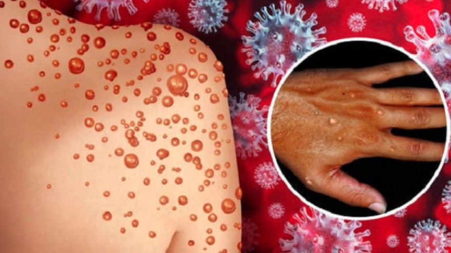 Fifth monkeypox case detected in Ho Chi Minh City