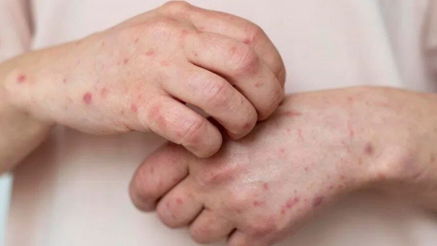 HCM City records four more monkeypox cases