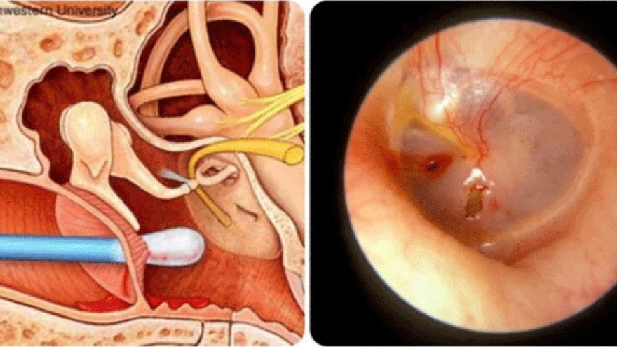 Hậu quả của việc thường xuyên ngoáy tai