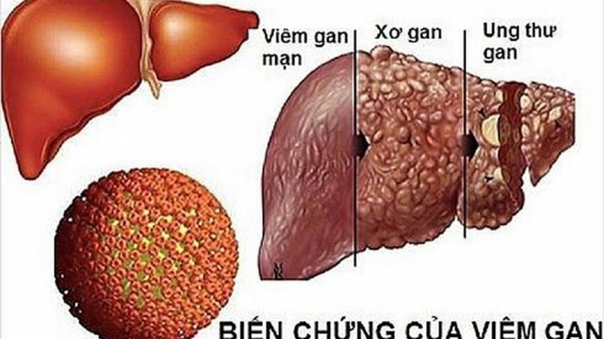 Tầm soát, phát hiện sớm ung thư gan bằng cách nào?