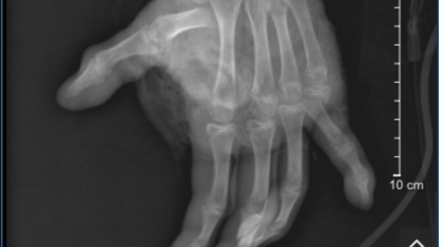 Bé trai Hà Nội dập nát bàn tay vì tự chế pháo