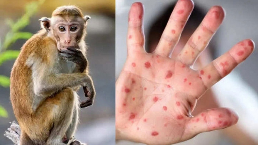 135 monkeypox cases recorded in Vietnam