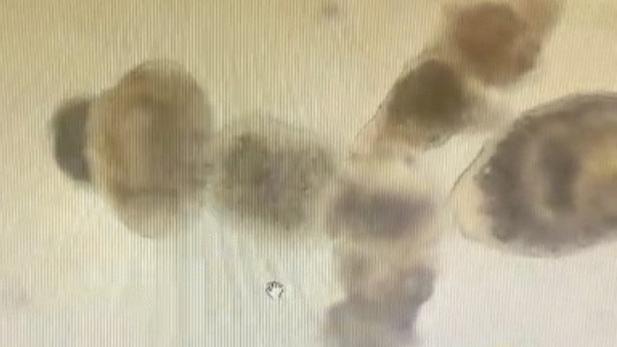 Người đàn ông nhiễm ấu trùng sán dây chó ký sinh tại phổi