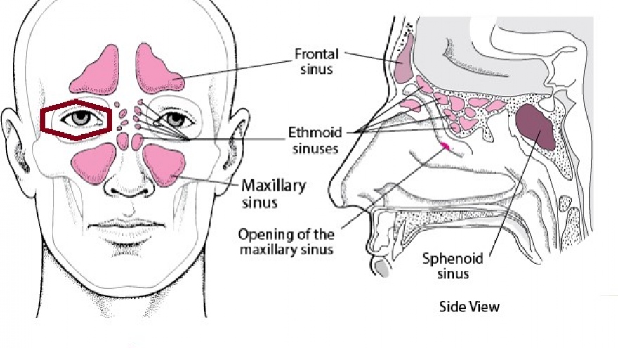 Vì sao viêm mũi xoang lại gây biến chứng, ảnh hưởng tới mắt?