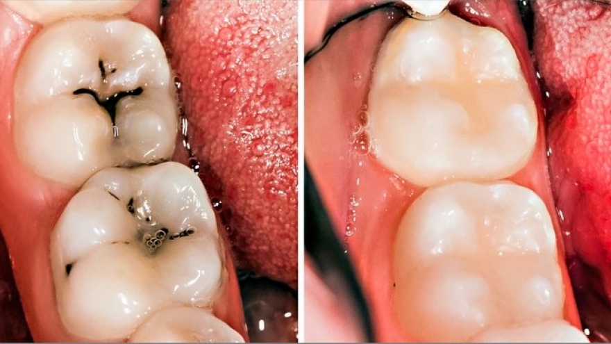 Những phương pháp đơn giản giúp cho răng miệng khỏe mạnh