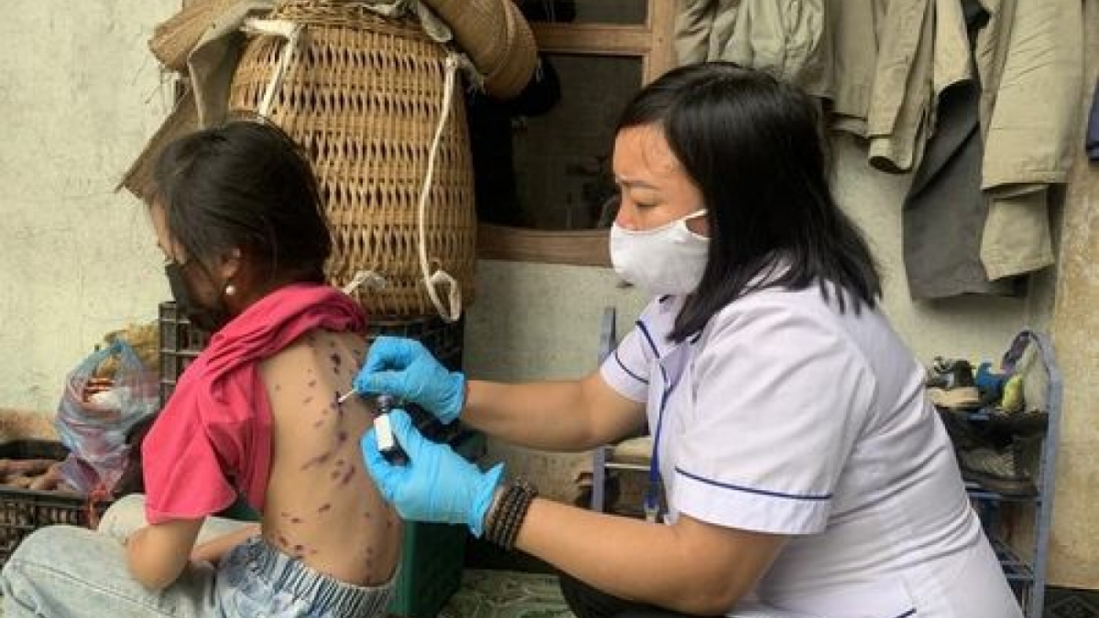 Thời tiết nồm ẩm: Đừng coi thường bệnh thủy đậu ở người lớn