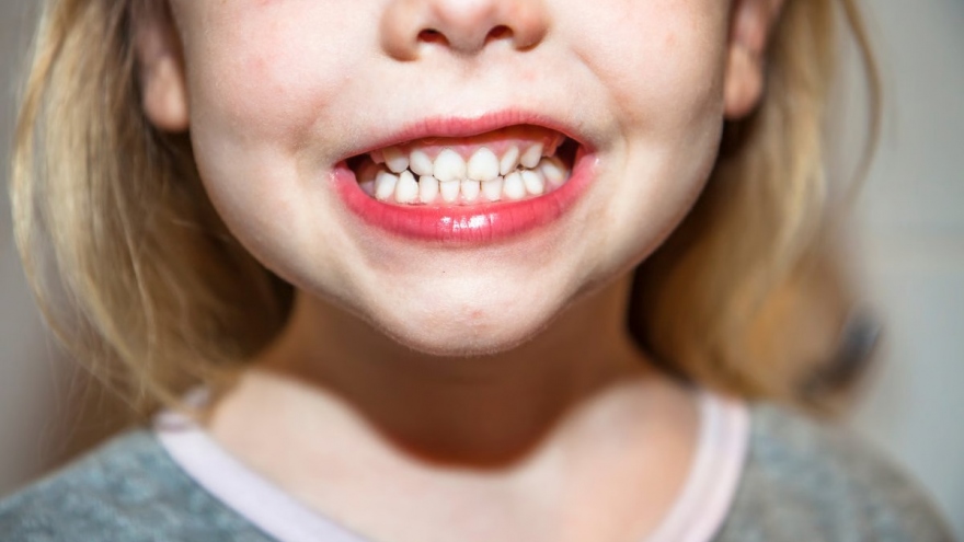 Phát hiện phương pháp mới điều trị sâu răng hiệu quả