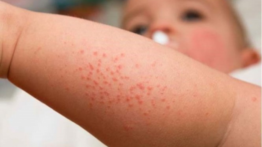 Hanoi capital sees first measles case this year