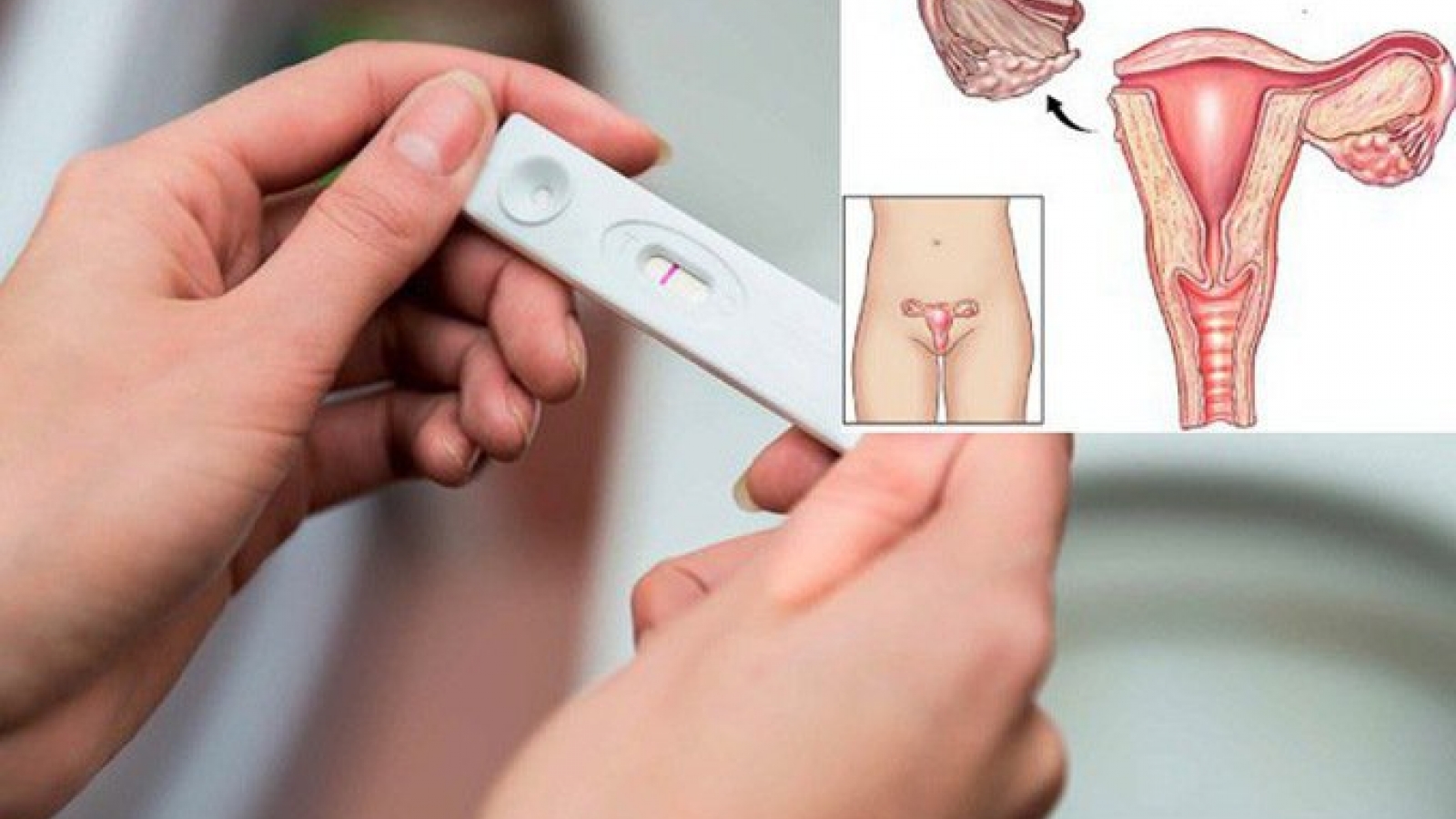 Cắt một bên ống dẫn trứng liệu có vô sinh?
