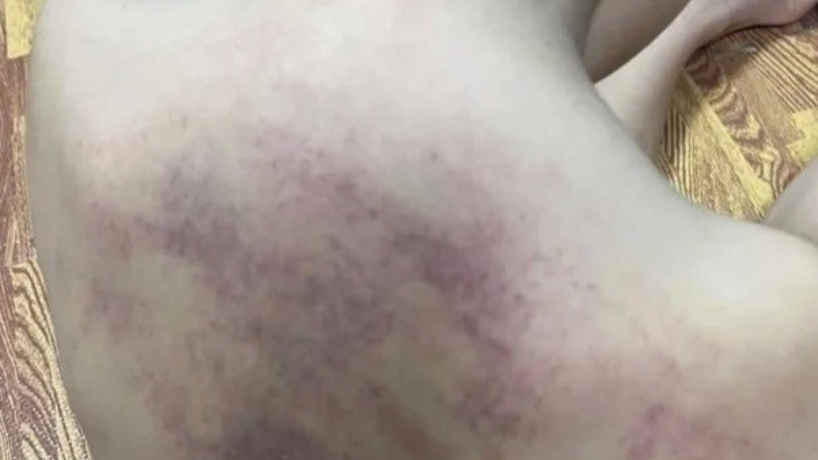 Khẩn trương làm rõ vụ cháu bé 5 tuổi ở Hải Phòng nghi bị bạo hành