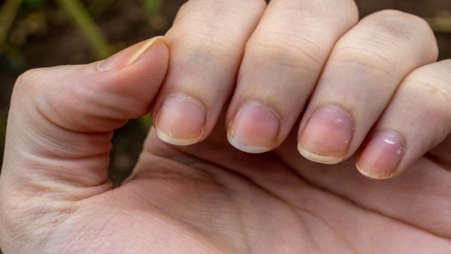 Dấu hiệu ít được chú ý trên móng tay có thể cảnh báo bạn về bệnh ung thư