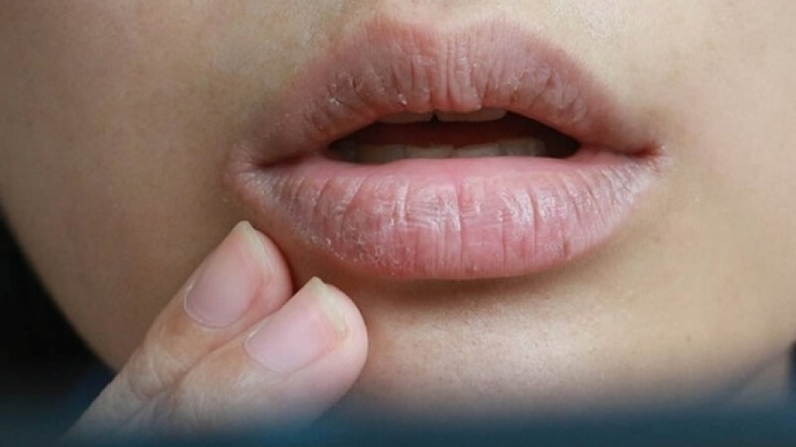Khô miệng có thể là “báo động đỏ” cho 5 căn bệnh nguy hiểm mà bạn chưa biết