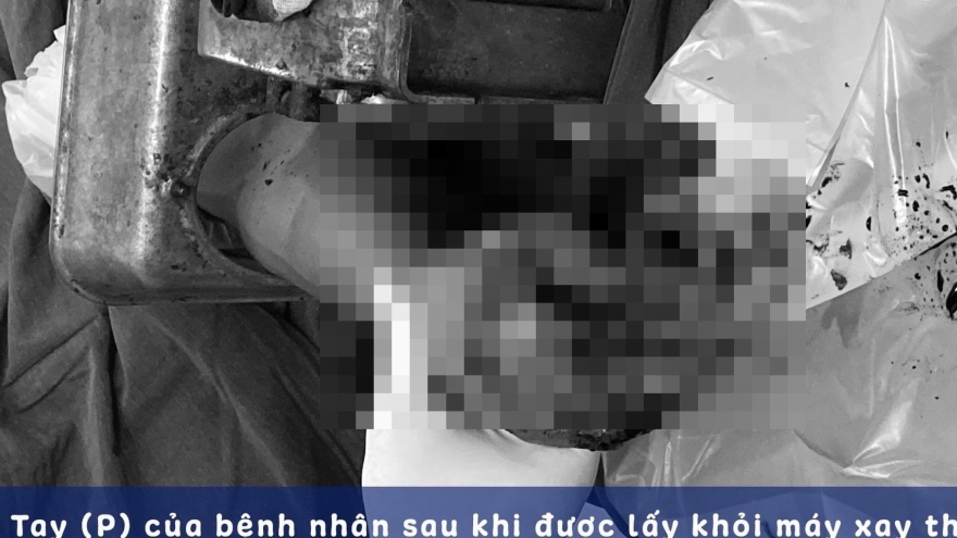 Bị máy xay thịt cuốn dập nát tay, người đàn ông mang cả máy xay đi cấp cứu