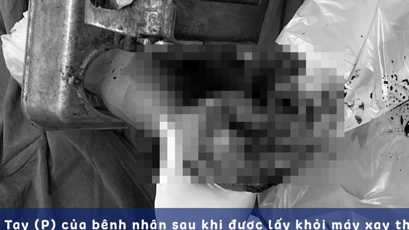 Bị máy xay thịt cuốn dập nát tay, người đàn ông mang cả máy xay đi cấp cứu