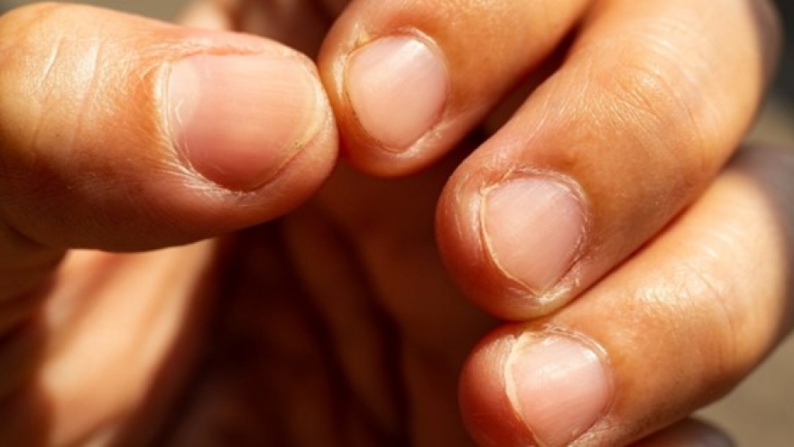 5 dấu hiệu bất thường trên móng tay tuyệt đối không coi nhẹ