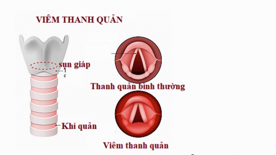 Bác sĩ tư vấn cách chữa trị bệnh khàn tiếng, khàn giọng