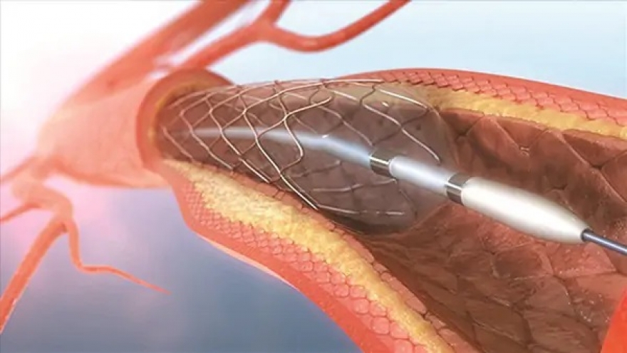 Kiêng cữ sinh hoạt vợ chồng thế nào sau khi đặt stent?