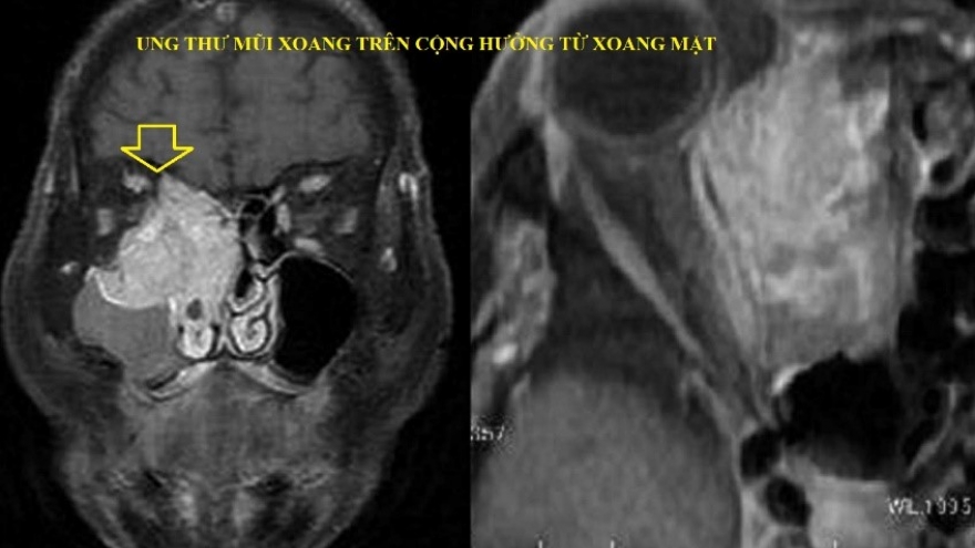 Ung thư mũi xoang được phát hiện nhờ biểu hiện đau vùng má