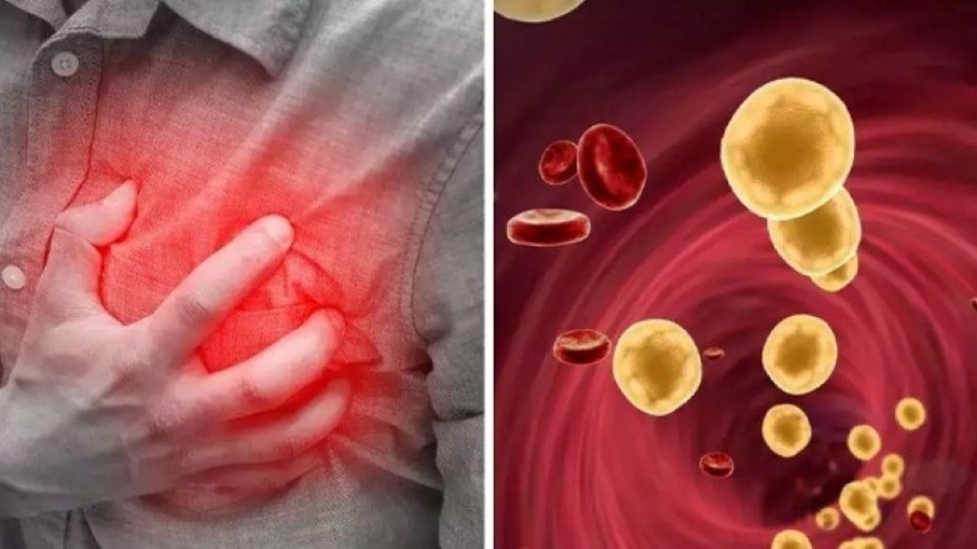 Những dấu hiệu cảnh báo sớm mỡ máu cao tuyệt đối đừng coi nhẹ