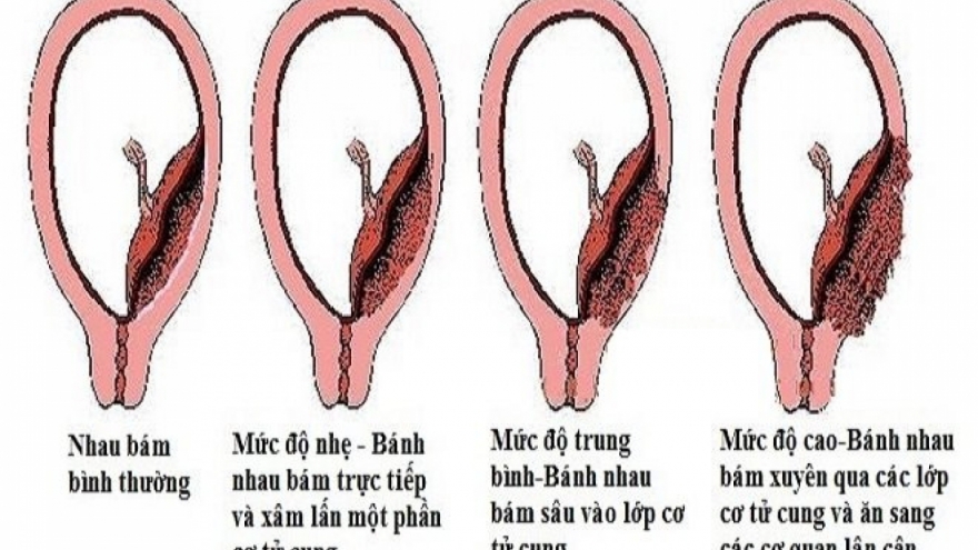 Nhau thai và các biến chứng nguy hiểm