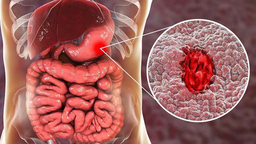 Xuất tinh ra máu có nguy hiểm không? Biến chứng tiềm ẩn?