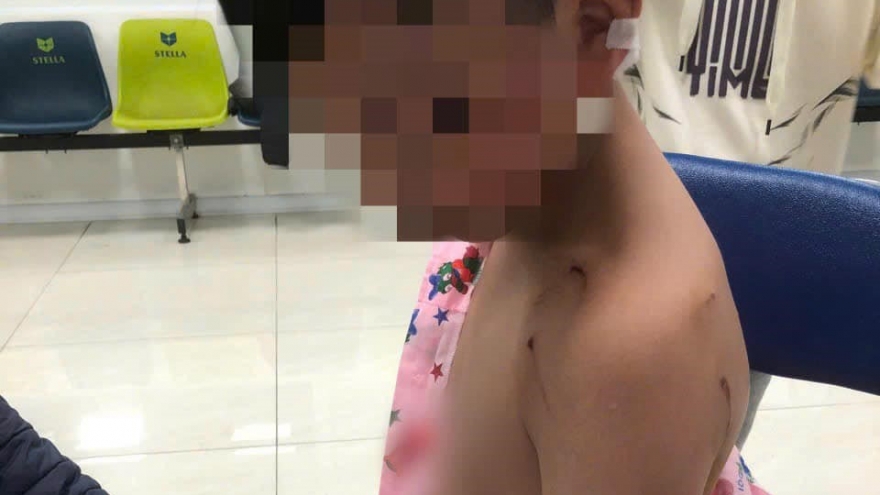 Bị chó tấn công khi đi chúc Tết, bé trai phải khâu 9 mũi