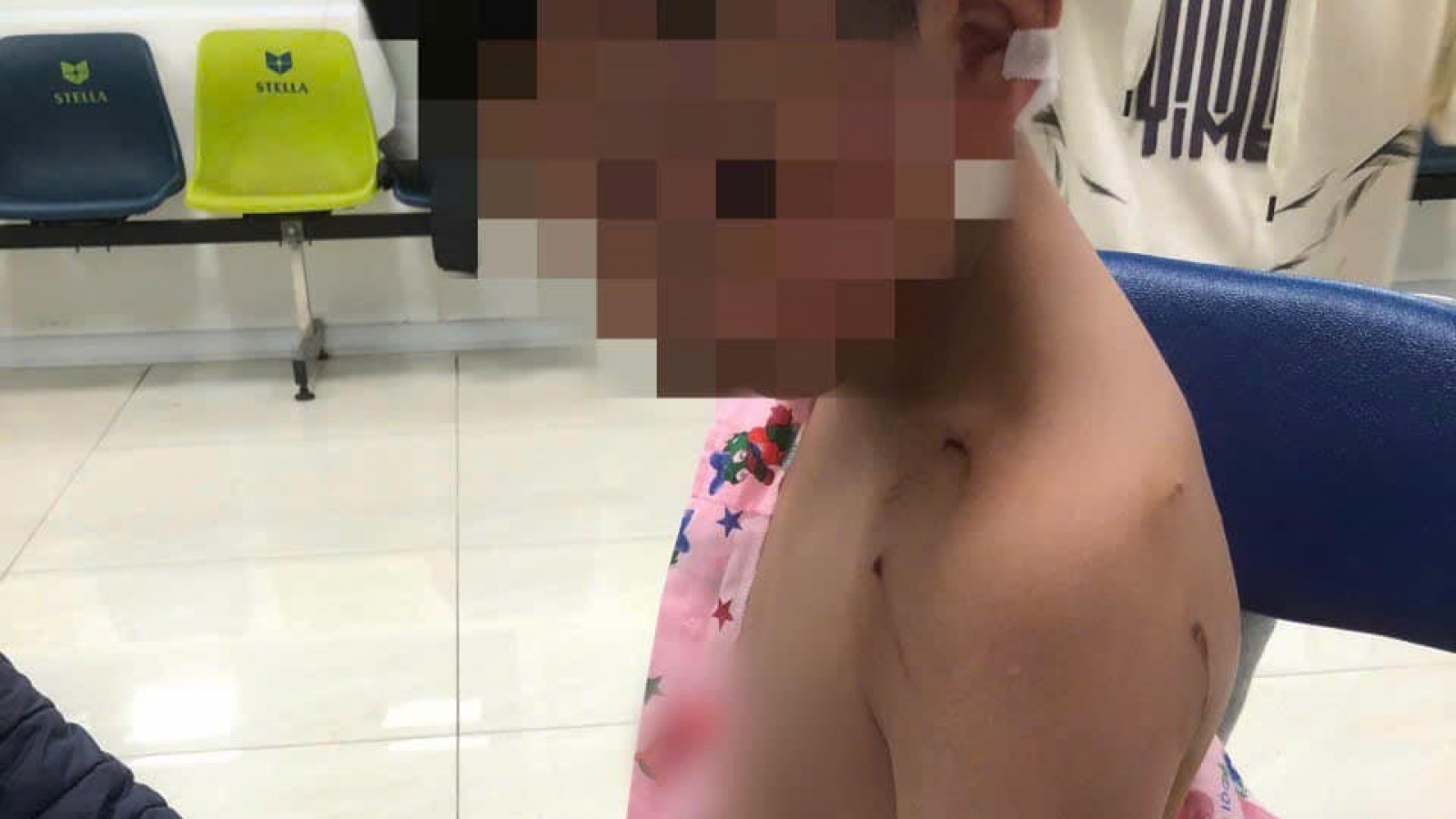 Bị chó tấn công khi đi chúc Tết, bé trai phải khâu 9 mũi