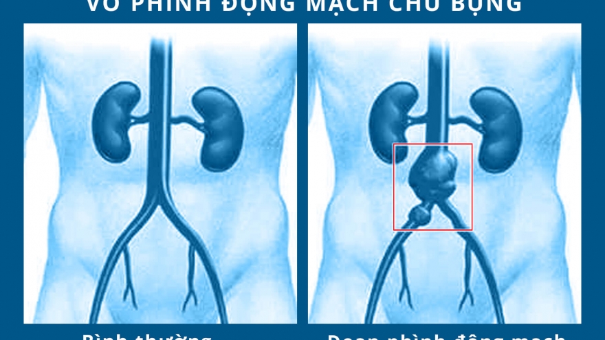 Bệnh phình động mạch chủ bụng và nguy cơ đối với việc quan hệ tình dục