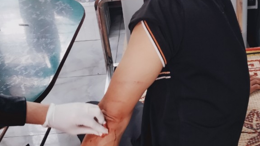 Đang làm việc, công nhân khai thác đá bị chém trọng thương