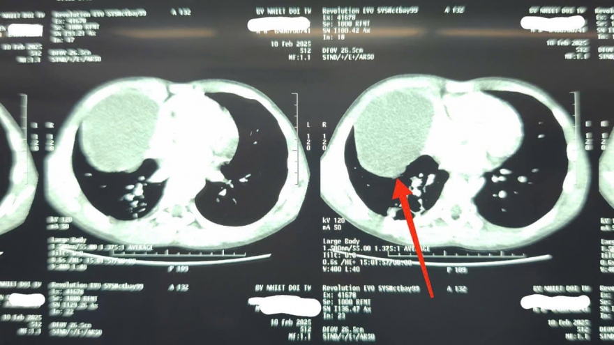 Bé trai 8 tuổi phát hiện bị bệnh phổi hiếm gặp sau một cú ngã