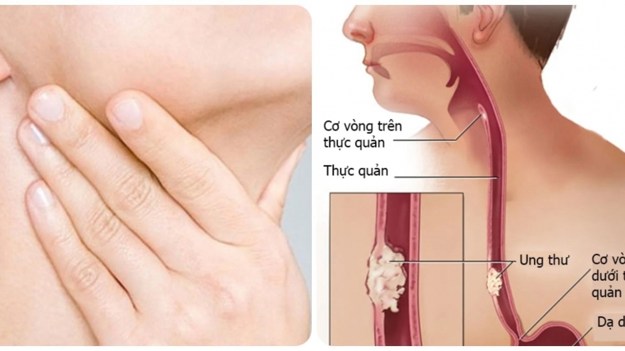 Dấu hiệu ung thư thực quản giai đoạn đầu ít ai biết