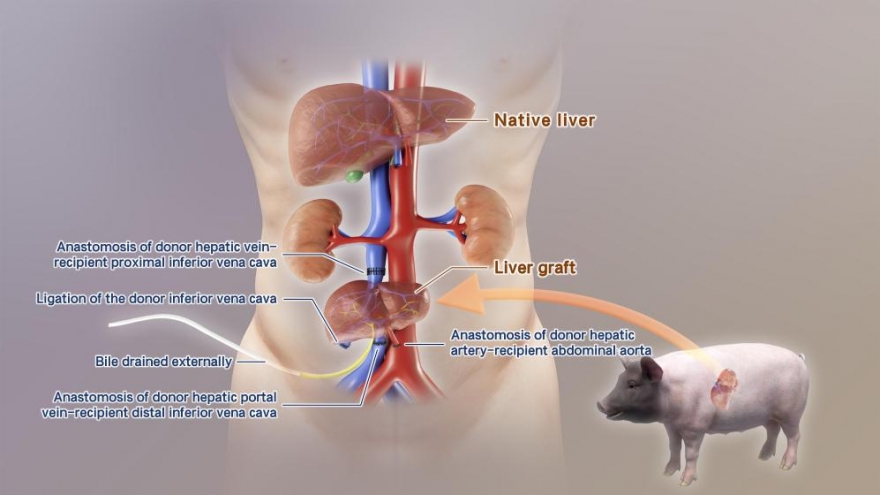 Trung Quốc cấy ghép thành công gan lợn chỉnh sửa gen vào cơ thể người
