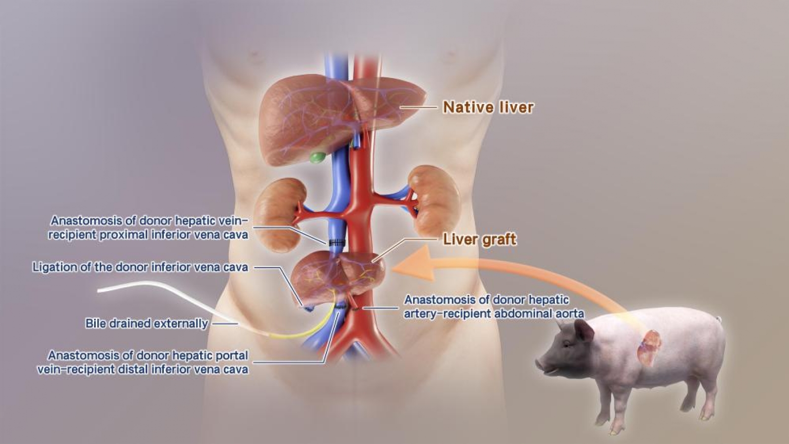 Trung Quốc cấy ghép thành công gan lợn chỉnh sửa gen vào cơ thể người