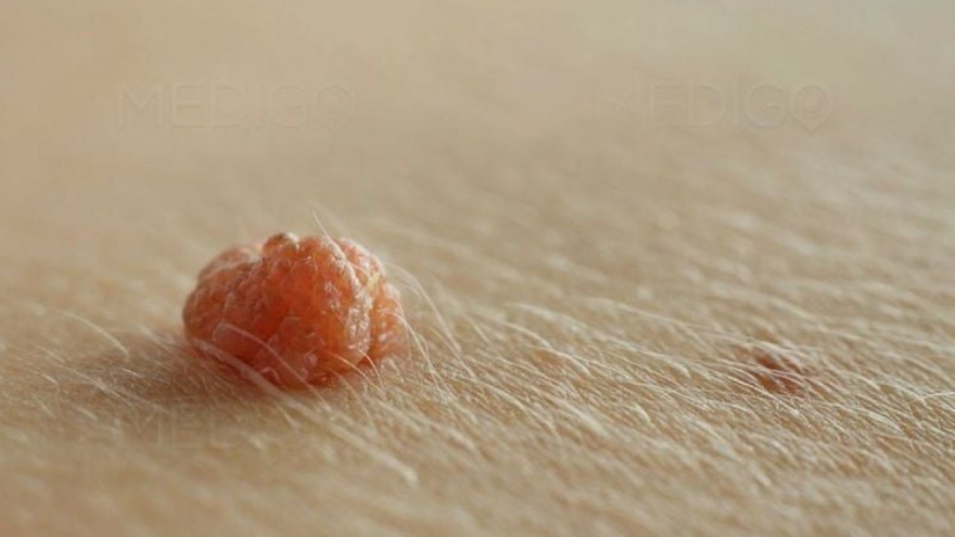 Virus HPV và những căn bệnh lây qua đường tình dục không chừa nam hay nữ