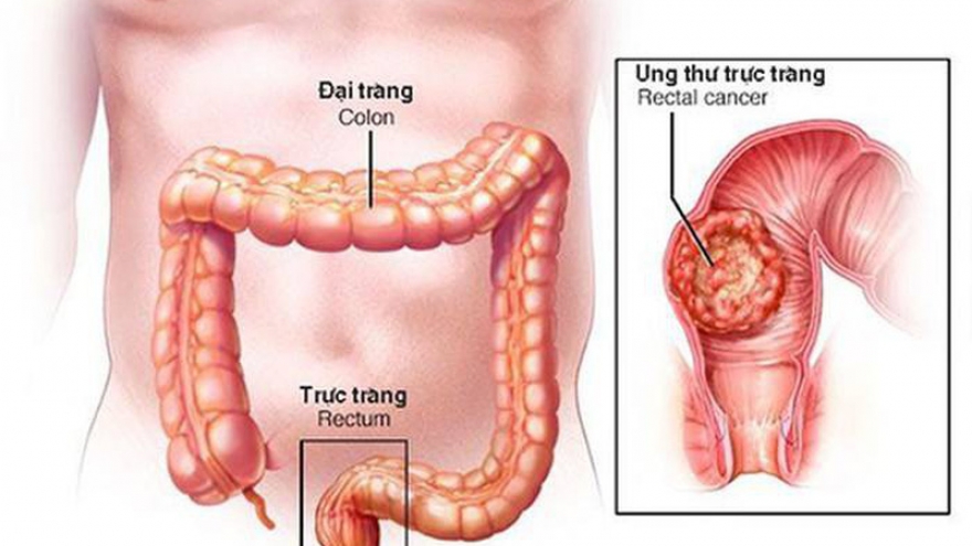 Ảnh hưởng của phẫu thuật ung thư trực tràng đến vấn đề tình dục