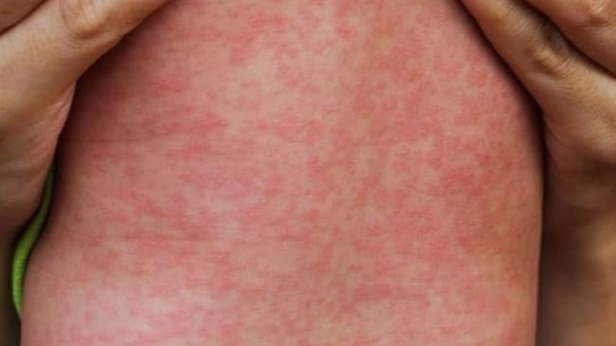5 khuyến cáo của Bộ Y tế trong phòng, chống bệnh sởi