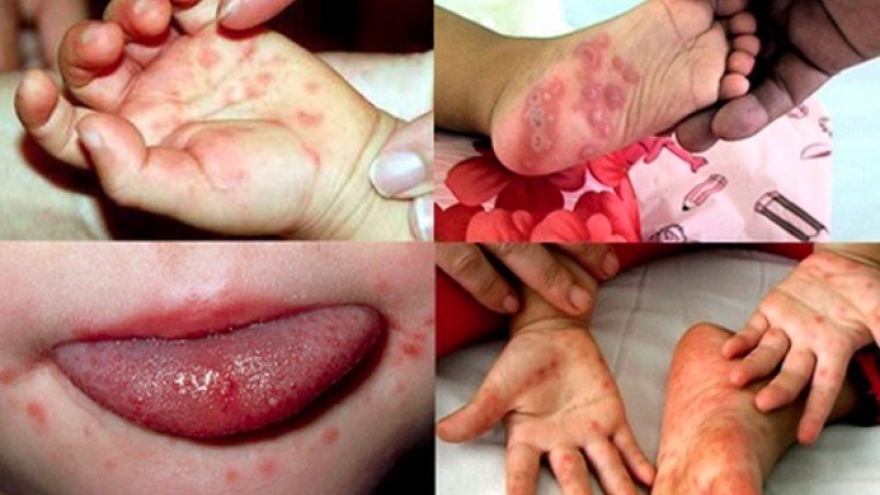 Hanoi records five HFMD outbreaks in one week