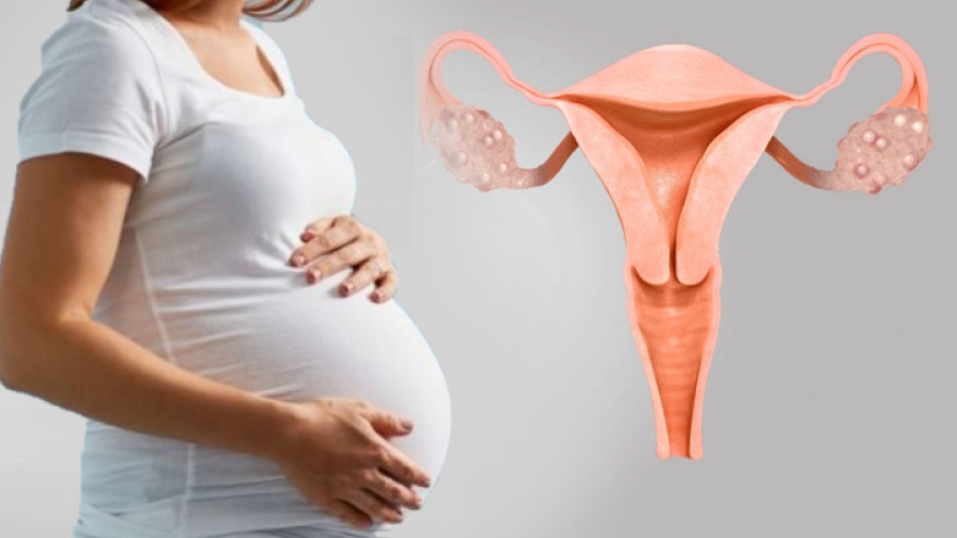 Tôi bị buồng trứng đa nang, kinh nguyệt không đều, liệu có thể mang thai tự nhiên?
